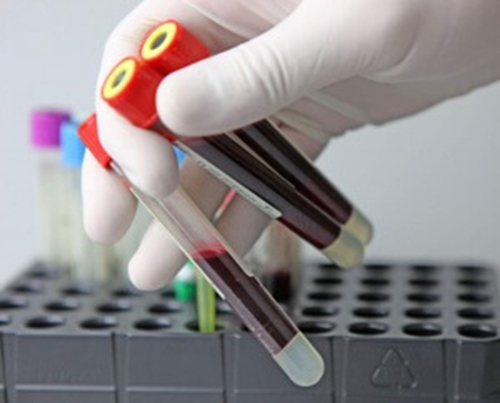 Новый тест позволит быстро оценить уровень ВИЧ в крови