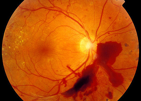 В США диагностикой диабетической ретинопатии займется искусственный интеллект