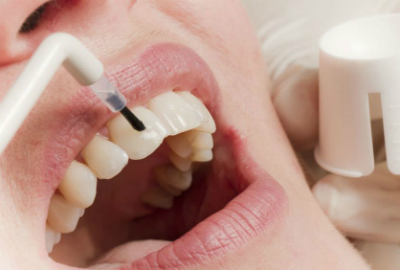 Уникальные наночастицы спасут от разрушения зубной эмали