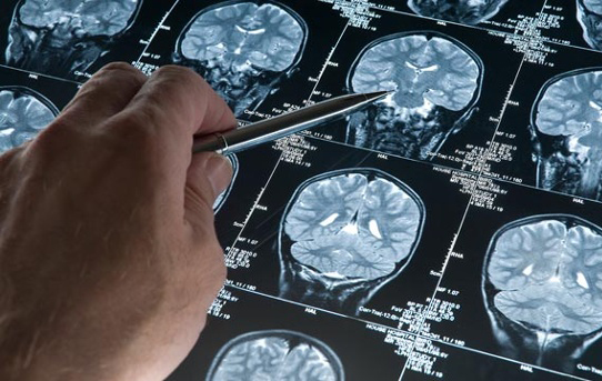 Ученые нашли способ быстрой диагностики болезни Альцгеймера