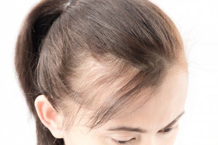 Продолжают выпадать: как восстановить волосы после COVID-19