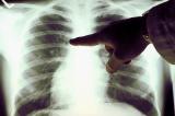 Նոր դեղը կավելացնի թոքերի քաղցկեղով հիվանդների կյանքի տեւողությունը. news.am