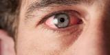 Покраснели глаза: причины и лечение