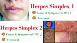 Հերպես (herpes simplex virus 1,2), igg հակամարմիններ հետազոտության նկարագրությունը. abmed.am