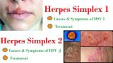 Հերպես (herpes simplex virus 1,2),  igg հակամարմիններ. հետազոտության նկարագրությունը