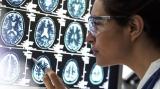 Лекарство от деменции: новый препарат донанемаб показал эффективность в борьбе против болезни Альцгеймера Деменция