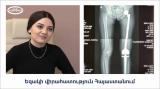 17 летняя девочка победила рак - уникальная операция в Армении. nairimed.com
