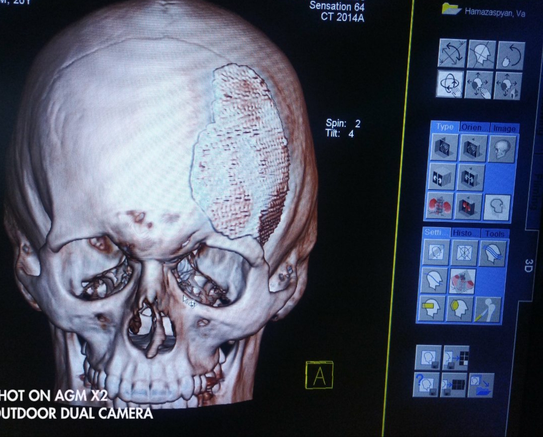 Устранение дефектов черепа с использованием титановых пластин в медицинском центре «Наири»