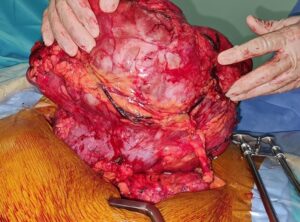 Опухоль размером с футбольный мяч хирурги ОАЭ удаляли у пациента 6 часов