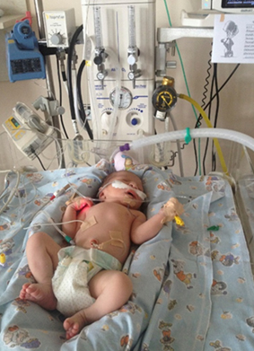 Նորածին, որը ստանում է ռեսպիրատոր թերապիա բարձր հոսքով