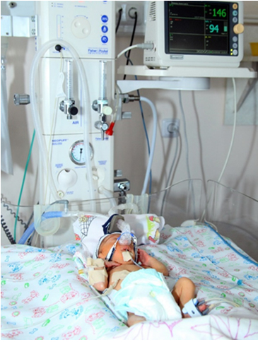 Недоношенный новорожденный получающий лечение методом BubbleCPAP в отделении реанимации новорожденных НИЦОЗИР