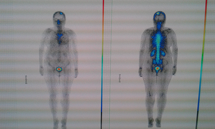  Остеосцинтиграфия: исследование костей скелета с помощью изотопа Тс-99