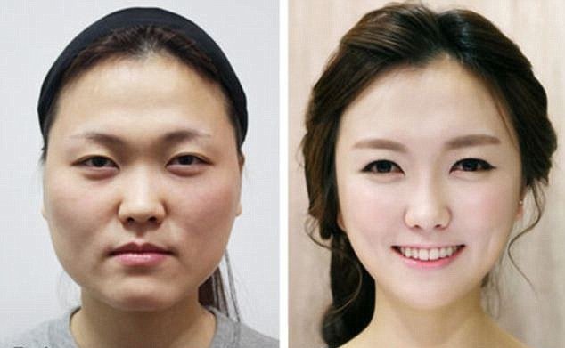 Հարավային Կորեա. դեմքի արմատական վիրաբուժություն