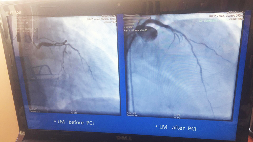 Կլինիկական դեպք. “Stent for life” ՀՀ պետական ծրագրի շրջանակներում