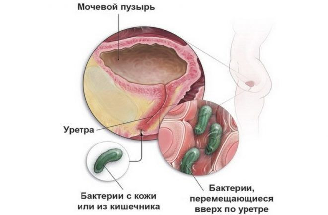  инфекционного процесса в мочевыводящих путях 